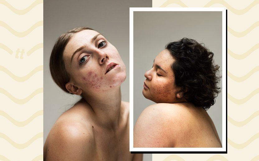 mulheres com acne