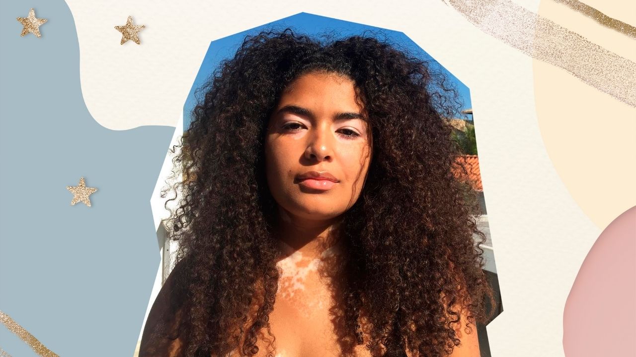Dia mundial do vitiligo: conheça 5 influenciadoras que te inspiram a aderir ao skin positivity
