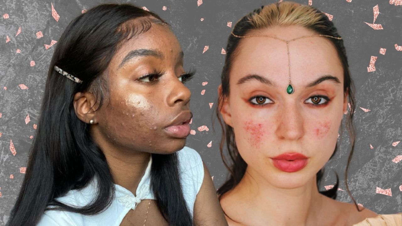 Acne Positivity: conheça o movimento e algumas influenciadoras adeptas