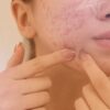 Acne na adolescência: o que é mito, o que é verdade e como tratar sem prejudicar a pele