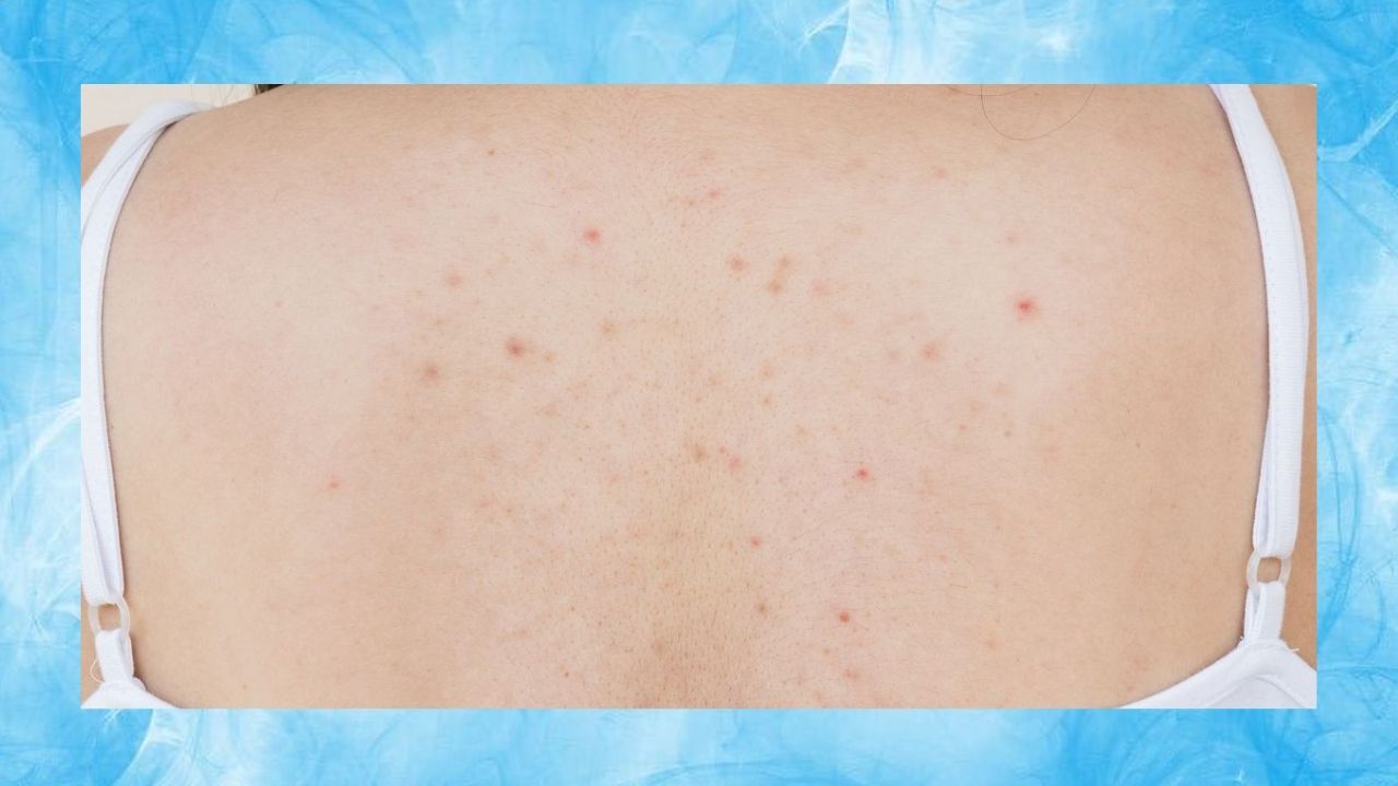 Espinhas nas costas: por que aparecem e como se livrar delas de vez!